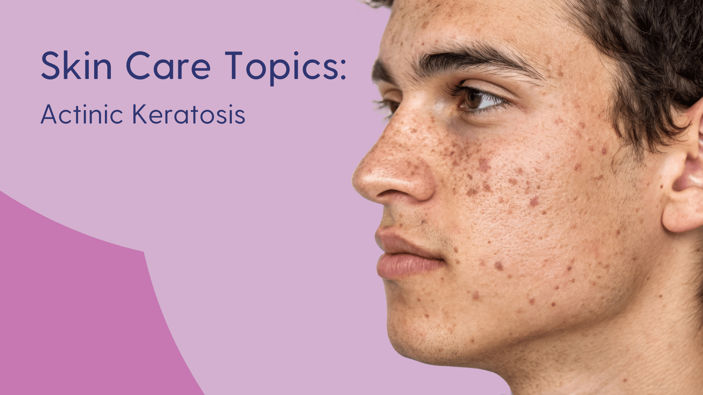 Actinic Keratosis: What It Is and What to Do About It