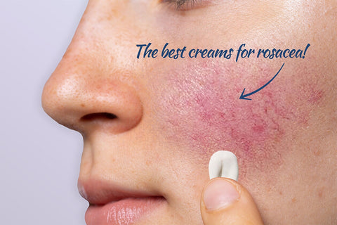 The best creams for rosacea