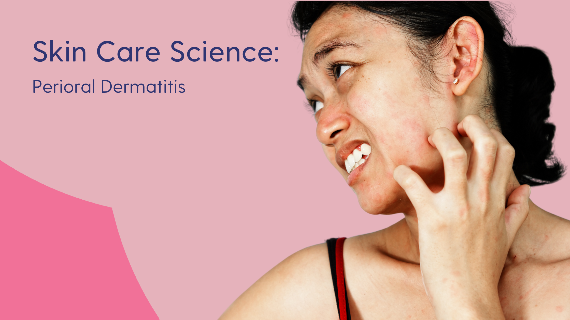 Perioral Dermatitis: What It Is & How to Treat It