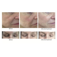 CO2LIFT Facial Mask CO2Lift PRO Carboxy Gel Treatment - Skin Type Solutions