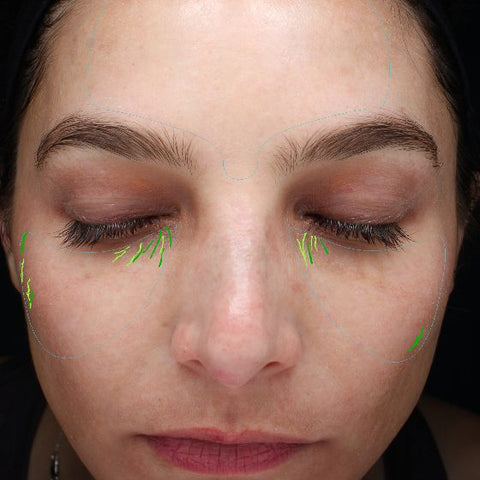 Skin analysis photo after six weeks on her routine, May 16, 2024