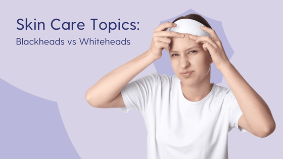 Blackheads vs whiteheads