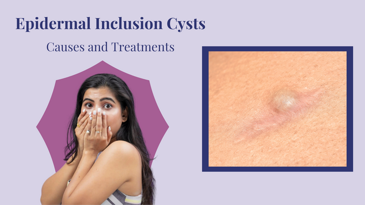 Epidermal Inclusion Cyst or Epidermoid Cyst