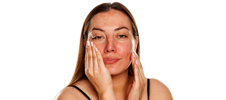 How To Get Rid of Melasma