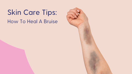 How to heal a bruise