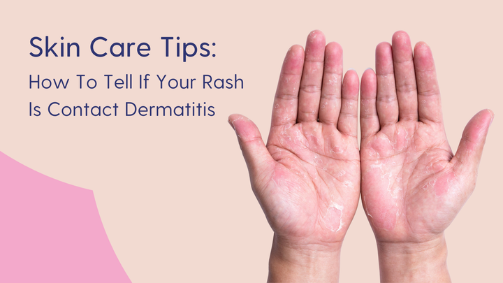 How to tell if a rash is contact dermatitis