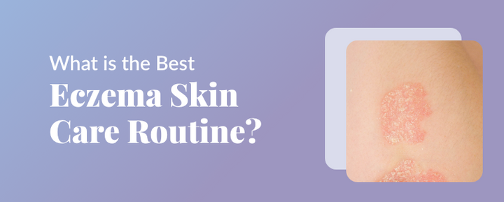 What is the best eczema skin care routine?