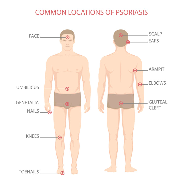 Common locations of psoriasis are the face, stomach, scalp, neck, armpit, elbows, glutes, knees, genitalia, navel, toes
