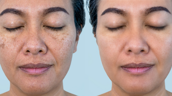 A woman before and after melasma treatment