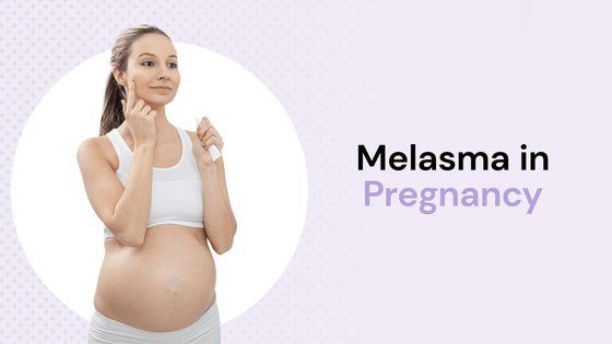 Melasma in pregnancy, a pregnant model