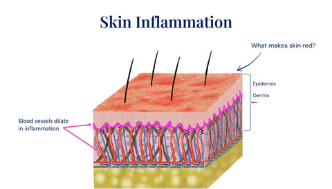 Skin inflammation above the skin layers