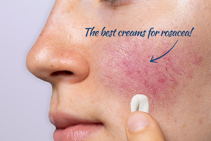 The best creams for rosacea