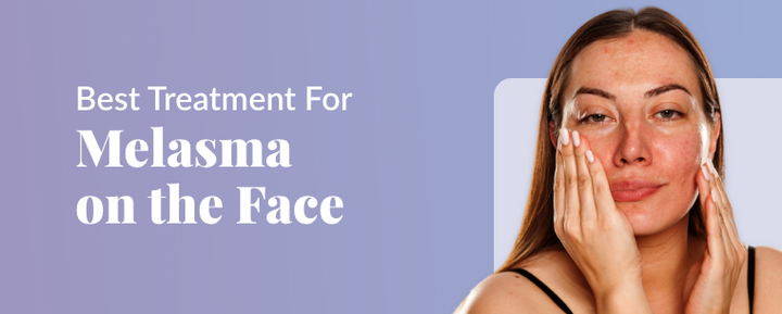 Best treatment for melasma on the face
