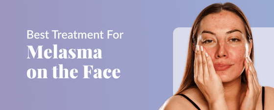 Best treatment for melasma on the face