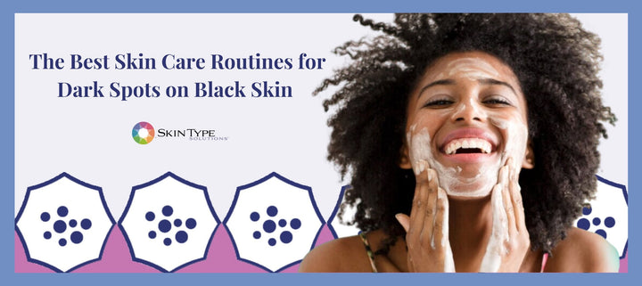 How To Get Rid Of Dark Spots On Black Skin