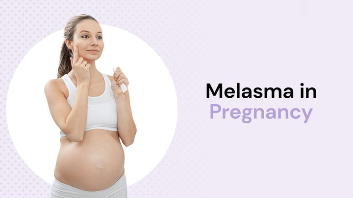 Melasma in Pregnancy