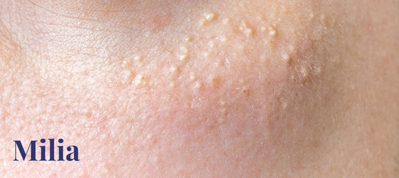 Milia and How To Remove Them
