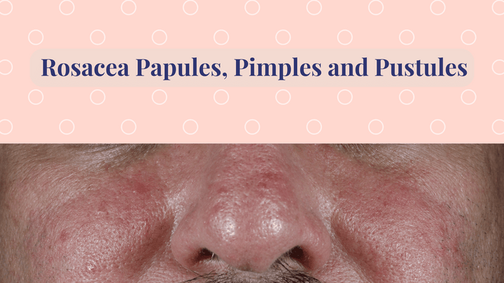 Rosacea Acne papules and pustules