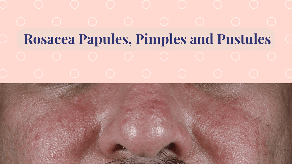 Rosacea Acne papules and pustules