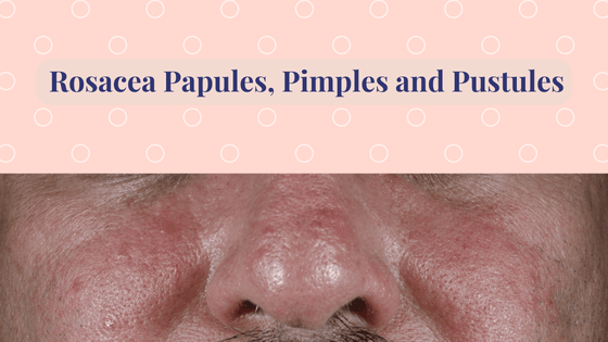 Rosacea Acne papules and pustules