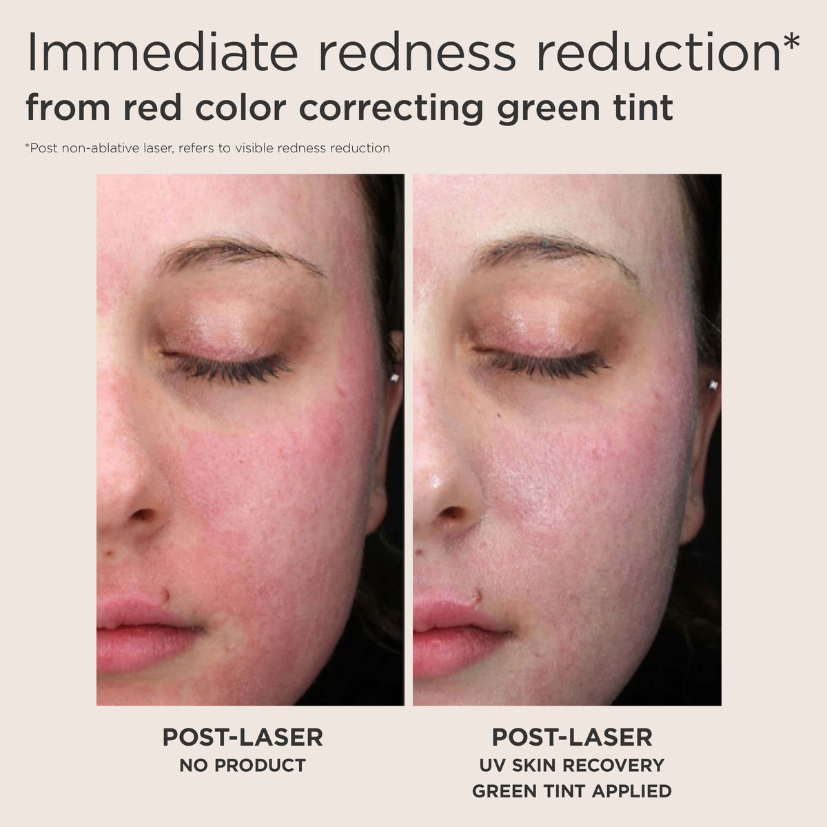 EltaMD Face & Body Sunscreen EltaMD UV Skin Recovery Red Color Correcting Green Tint Broad Spectrum SPF 50 - Skin Type Solutions