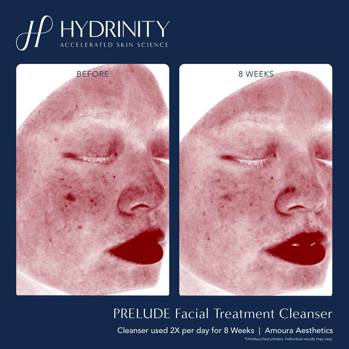 Hydrinity Face & Body Cleansers Hydrinity PRELUDE Facial Treatment Cleanser - Skin Type Solutions