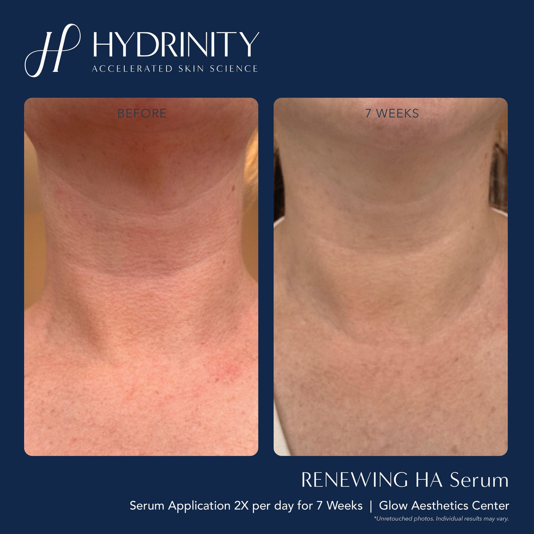 Hydrinity Hydrinity Treatments & Serums Hydrinity Renewing HA Serum - Skin Type ...