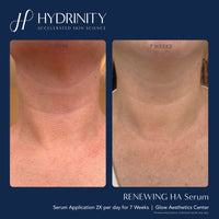 Hydrinity Treatments & Serums Hydrinity Renewing HA Serum - Skin Type Solutions