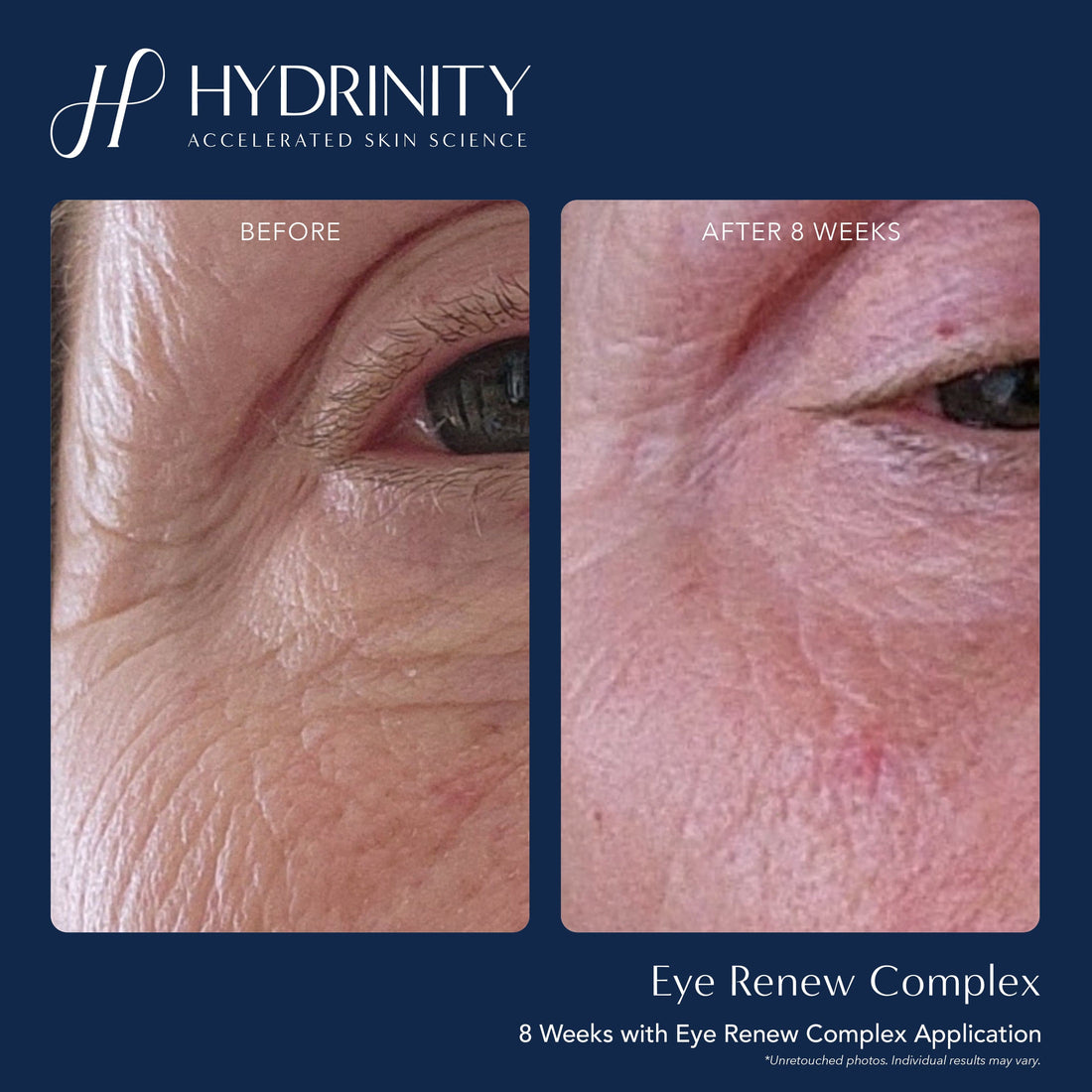 Hydrinity Reye Complex Hydrinity Eye Creams Hydrinity Eye Renew Complex - Skin Type Solutions