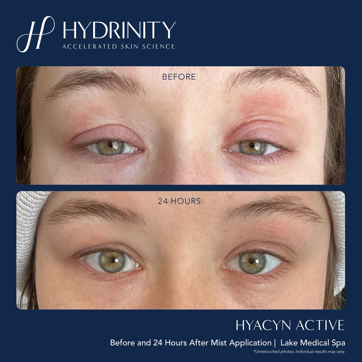 Hydrinity Facial Mist Hydrinity Hyacyn Active Purifying Mist - Skin Type Solutions