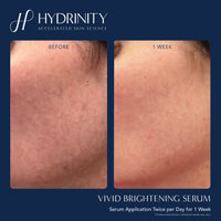 Hydrinity Treatments & Serums Hydrinity VIVID Brightening Serum - Skin Type Solutions
