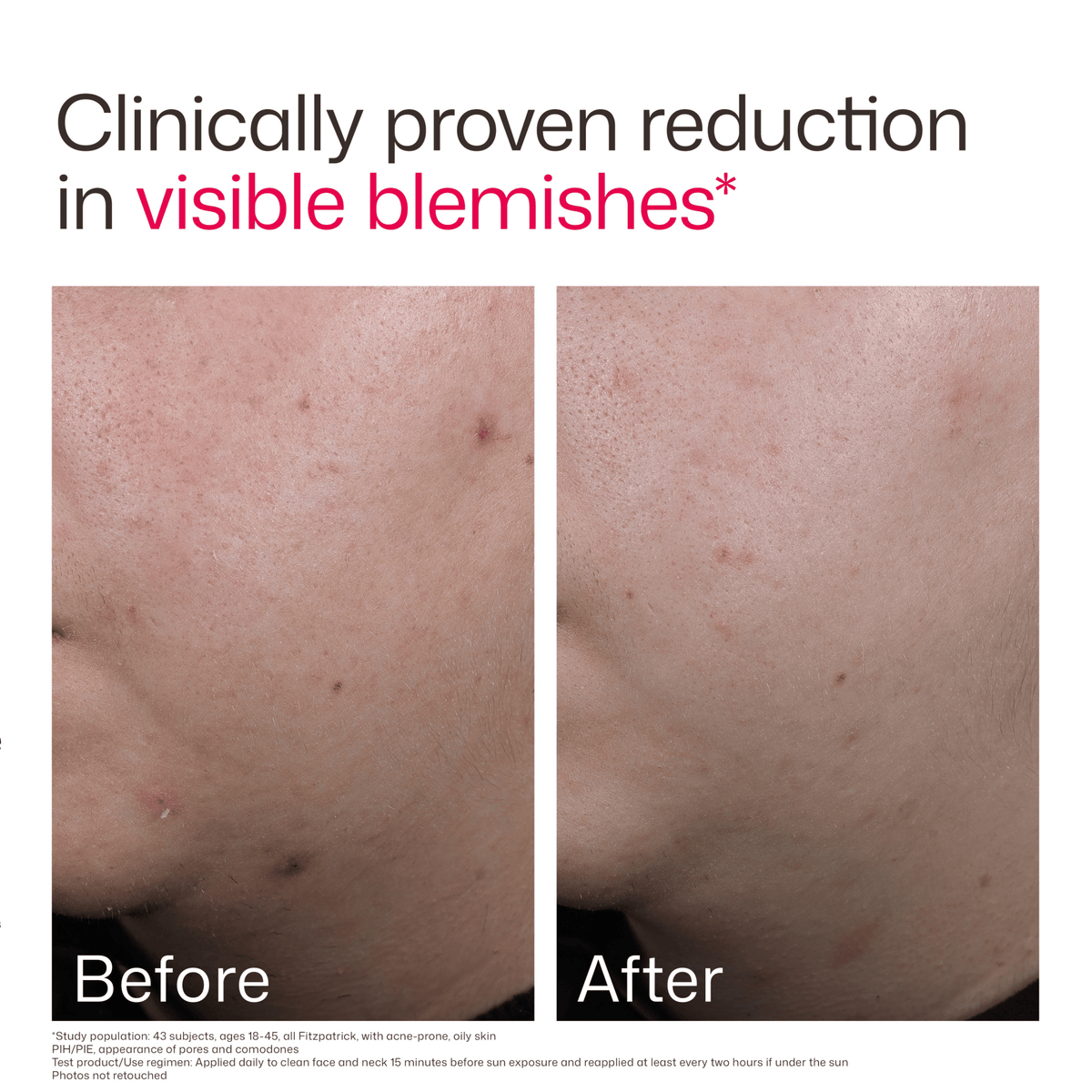 EltaMD Sunscreen EltaMD UV Clear Acne Blemish-Prone & Oil Balancing SPF 50 - Skin Type Solutions