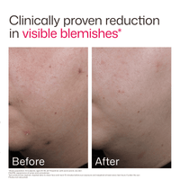 EltaMD Sunscreen EltaMD UV Clear Acne Blemish-Prone & Oil Balancing SPF 50 - Skin Type Solutions