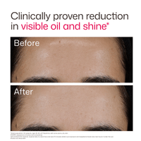 EltaMD Sunscreen EltaMD UV Clear Acne Blemish-Prone & Oil Balancing SPF 50 - Skin Type Solutions