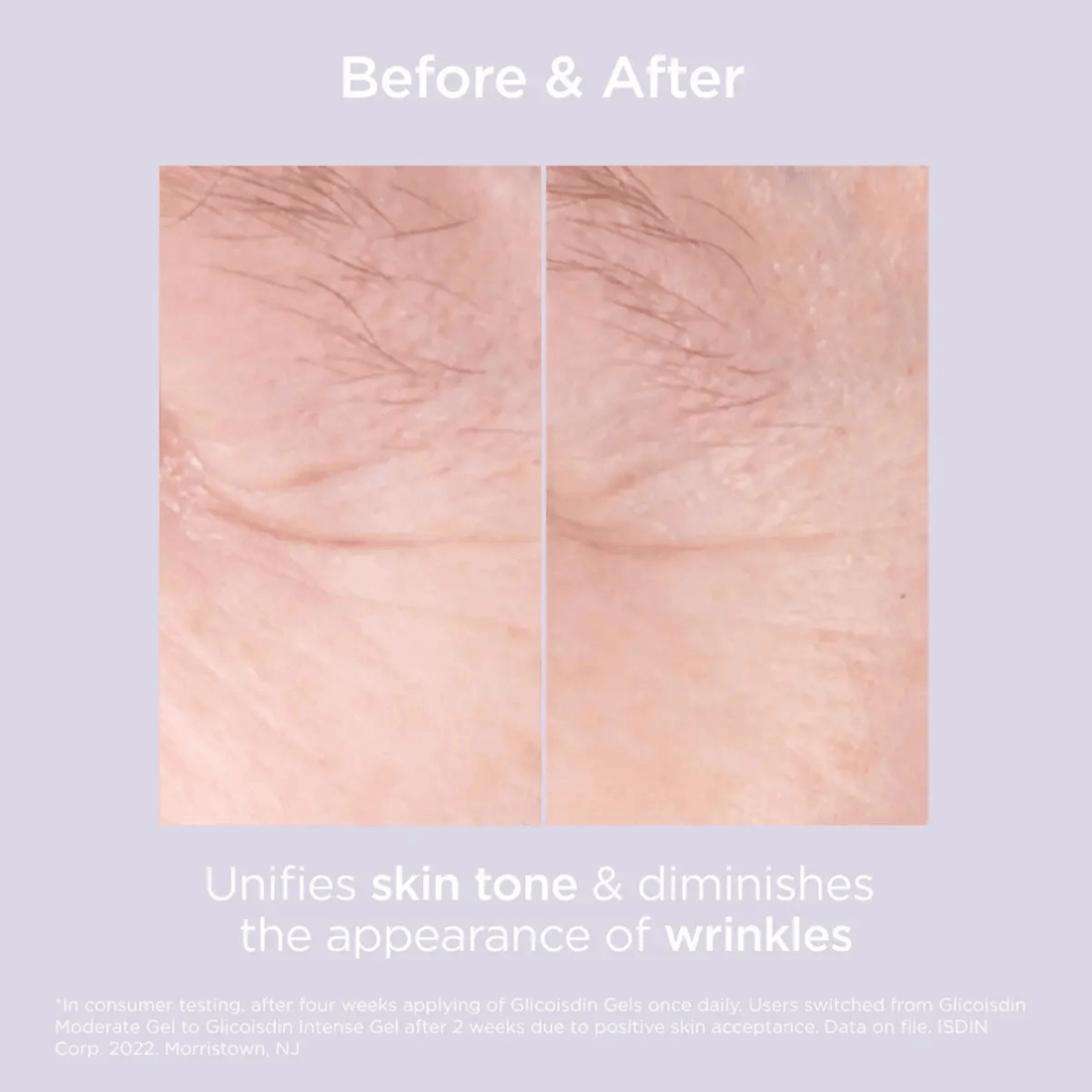 ISDIN Facial Treatment 1.7 oz. ISDIN Glicoisdin 15 Moderate Exfoliating Glycolic Acid Face Gel - Skin Type Solutions