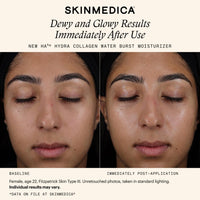 SkinMedica Face Moisturizers SkinMedica HA5 Hydra Collagen Water Burst Moisturizer - Skin Type Solutions