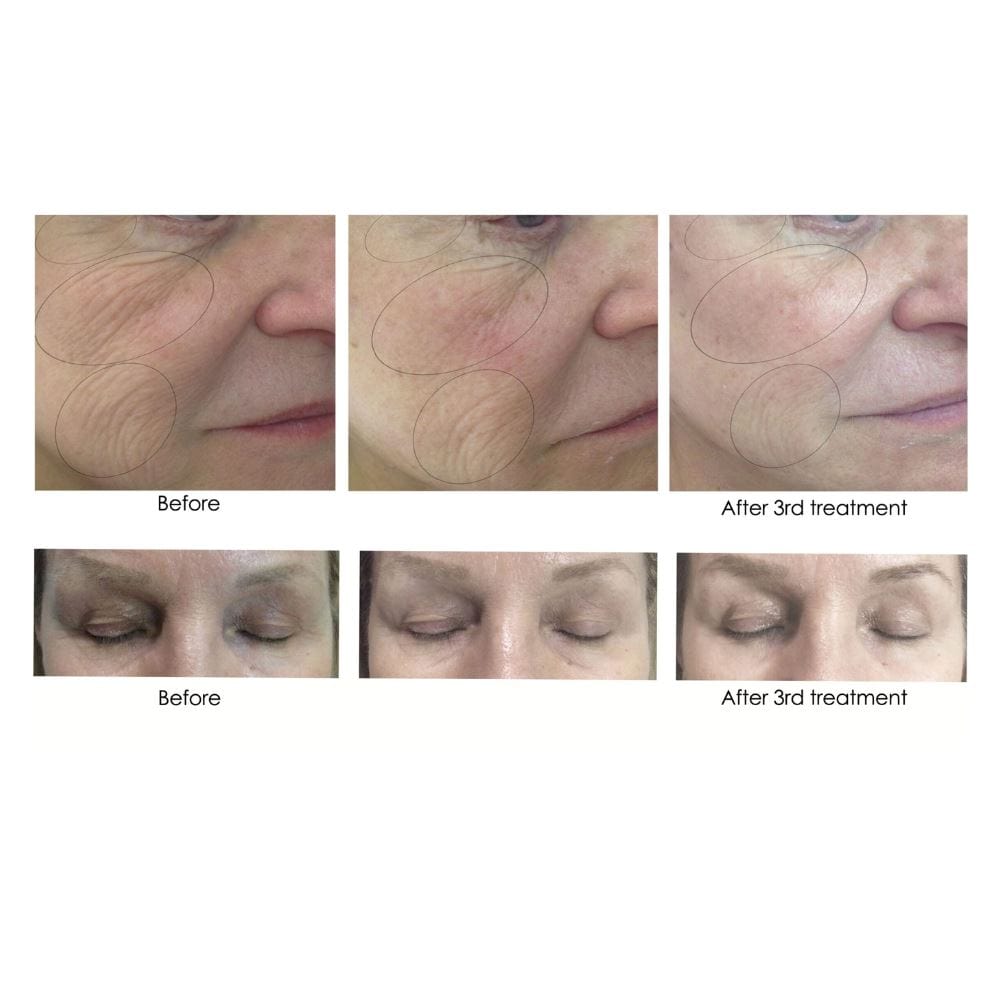 CO2LIFT Facial Mask CO2Lift PRO Carboxy Gel Treatment - Skin Type Solutions