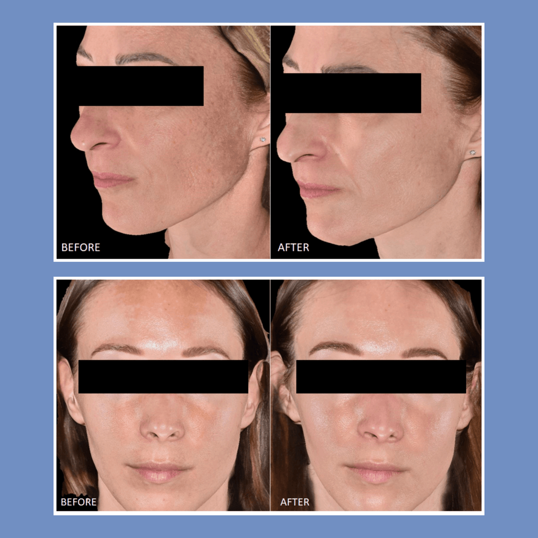 Cyspera Intensive Pigment Corrector 7% Cysteamine – Skin Type Cyspera Intensive Pigment Corrector 7% Cysteamine – Skin Type