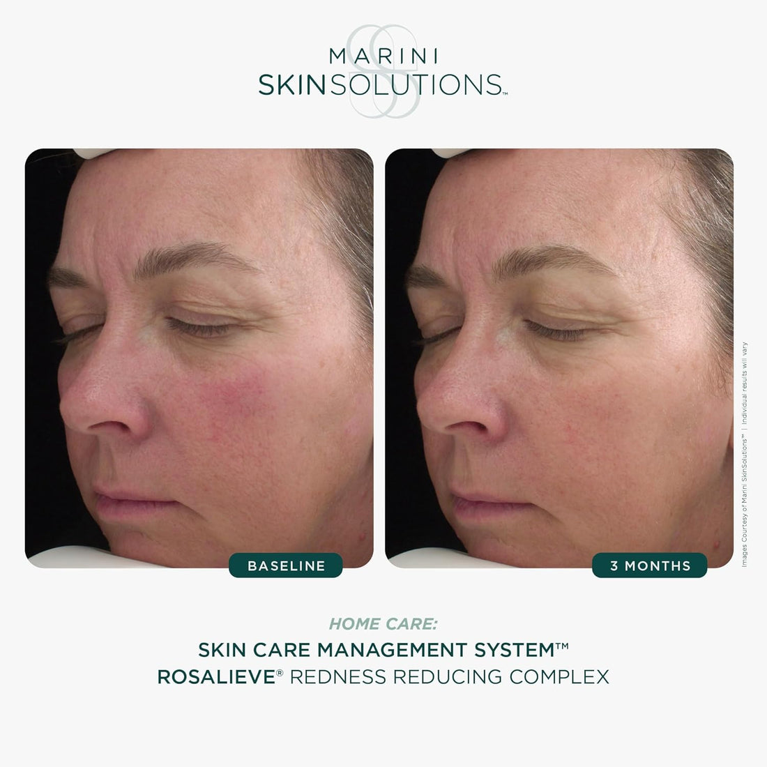 RosaLieve Redness Reducing Complex | Skin Type Solutions RosaLieve Redness Reducing Complex | Skin Type Solutions