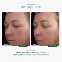 Jan Marini Face & Body Treatment 1 fl. oz. Marini Skin Solutions RosaLieve Redness Reducing Complex - Skin Type Solutions