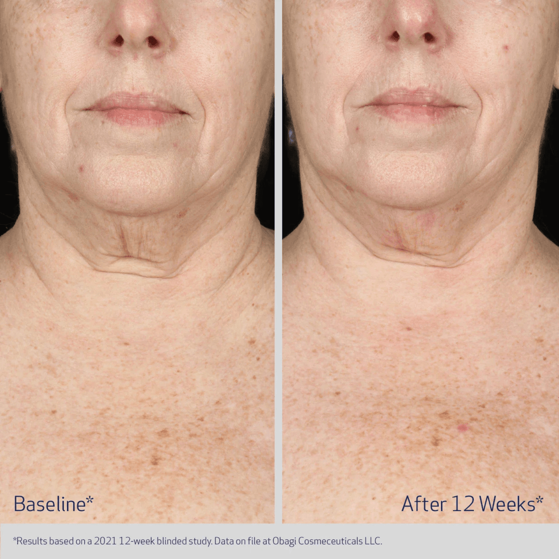 Obagi Body Moisturizer Obagi ELASTIderm Neck and Decollete Concentrate - Skin Type Solutions
