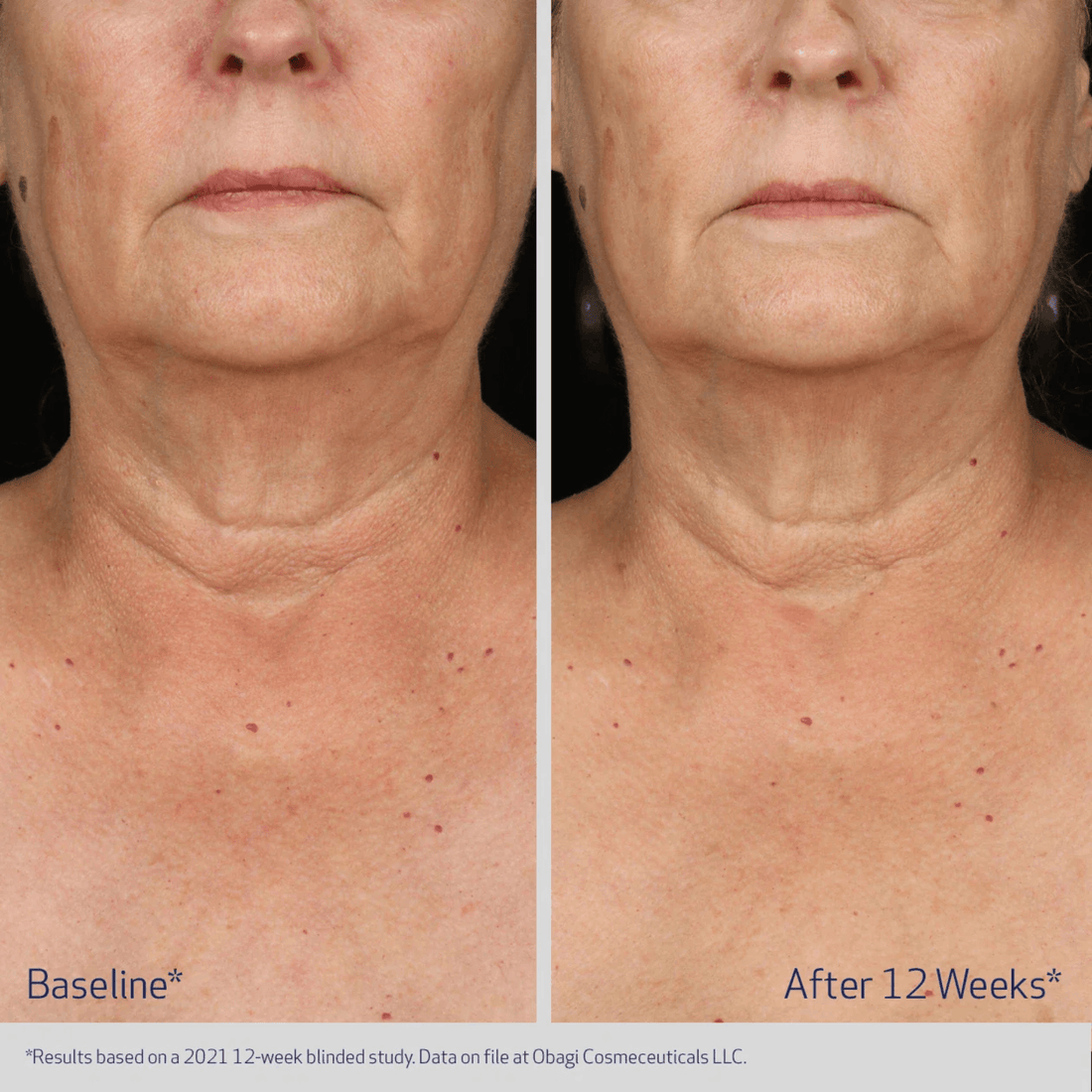 Obagi Body Moisturizer Obagi ELASTIderm Neck and Decollete Concentrate - Skin Type Solutions