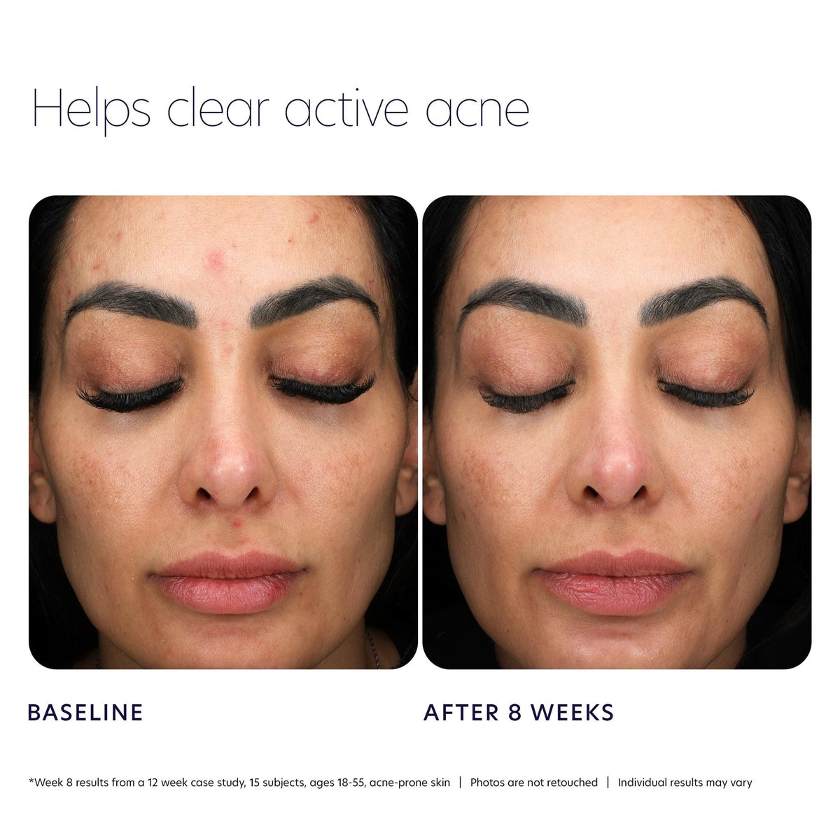 PCA Skin Facial Cleanser 7 fl. oz PCA Skin Acne Control Prebiotic Gel Cleanser - Skin Type Solutions