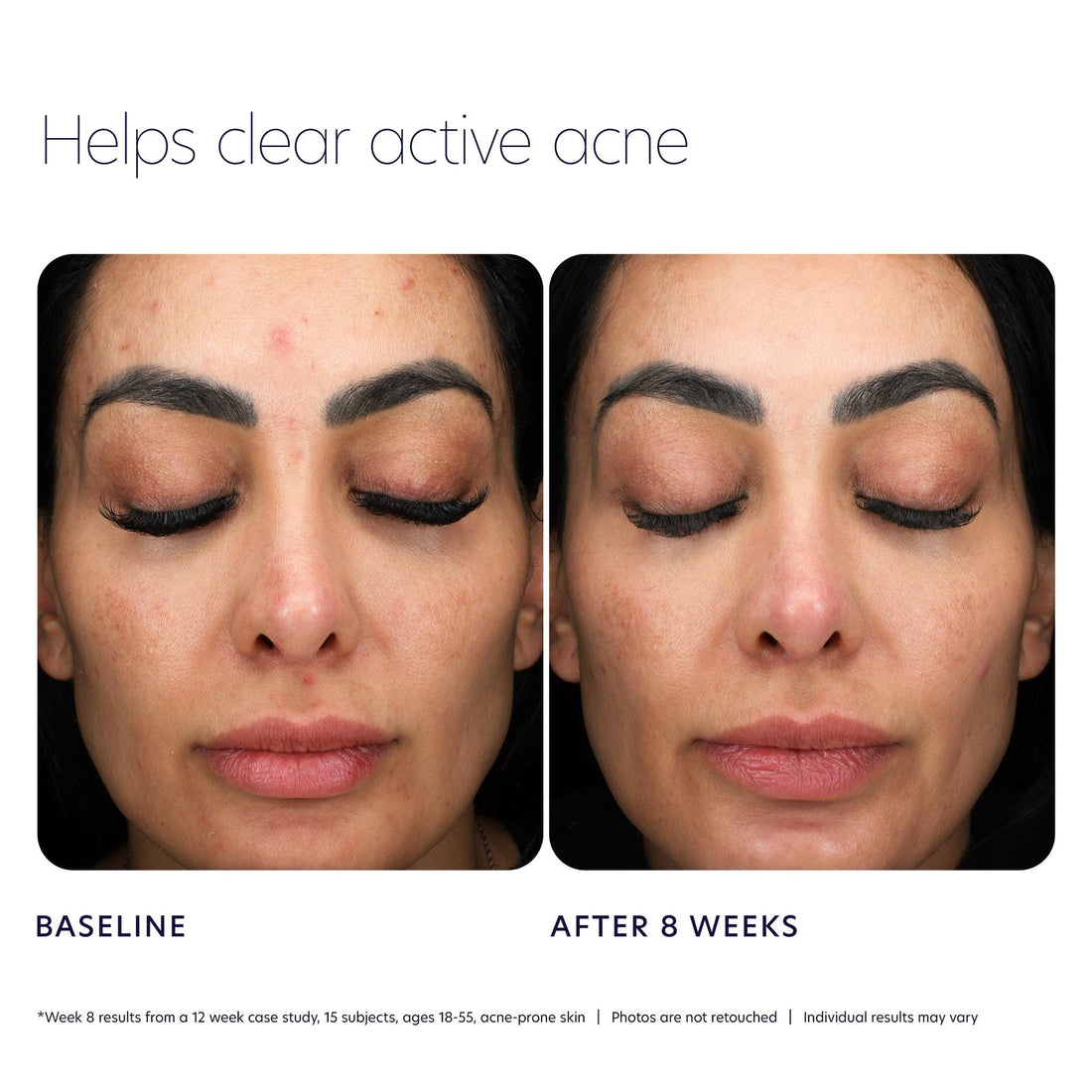PCA Skin Facial Cleanser 7 fl. oz PCA Skin Acne Control Prebiotic Gel Cleanser - Skin Type Solutions