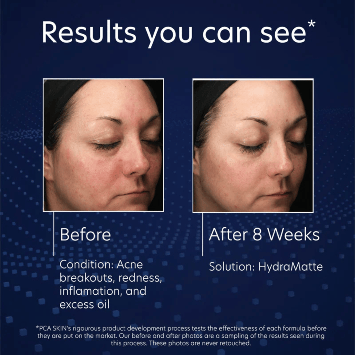 PCA Skin Facial Moisturizer 1.8 oz. PCA Skin HydraMatte - Skin Type Solutions