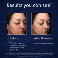 PCA Skin Facial Moisturizer 1.8 oz. PCA Skin HydraMatte - Skin Type Solutions