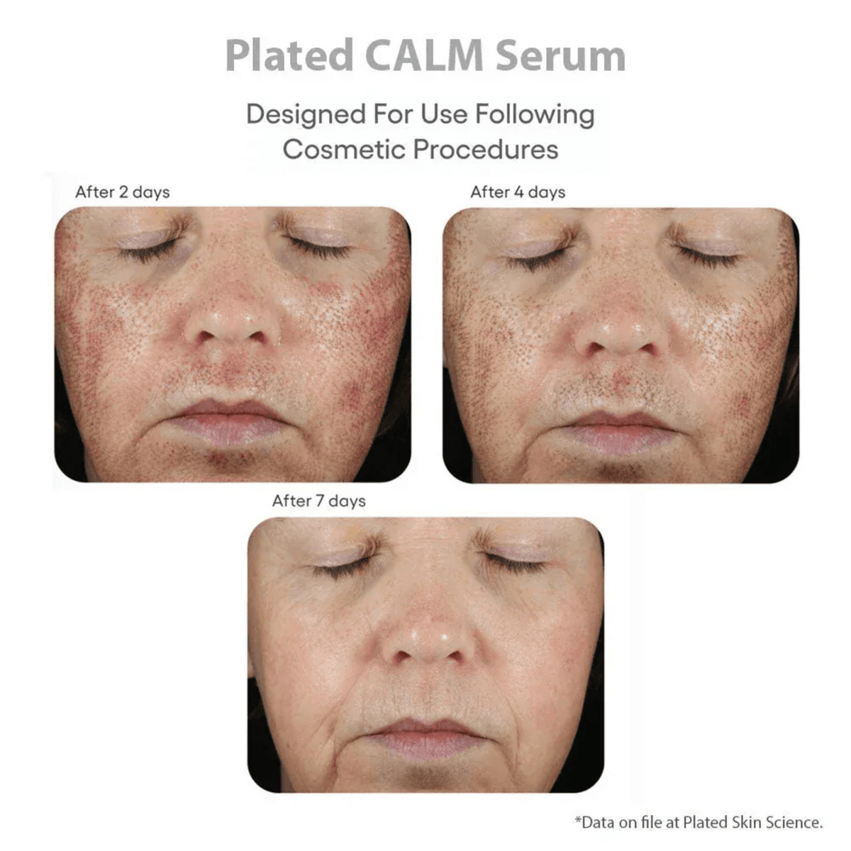 Plated Skin Science Microneedling 0.5 oz. Plated Skin Science CALM Post-Procedure Serum - Skin Type Solutions