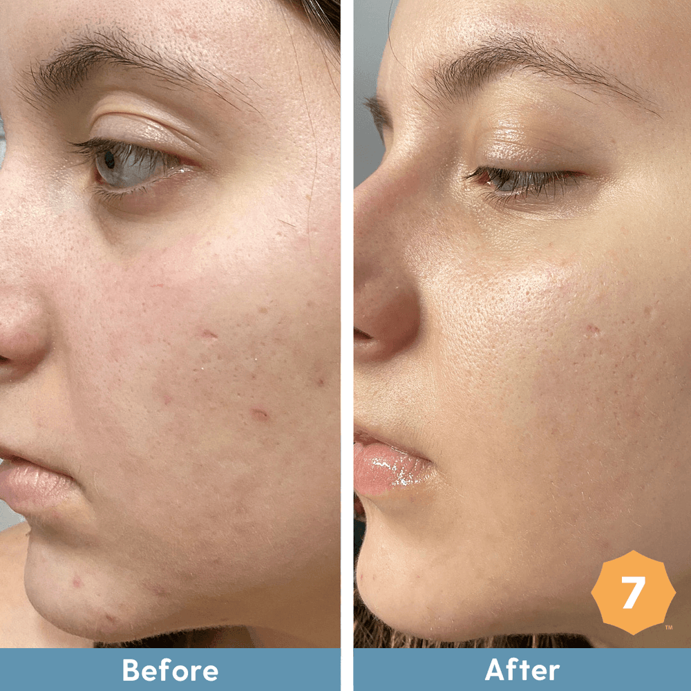 Before and after a Skin Type Solutions routine
