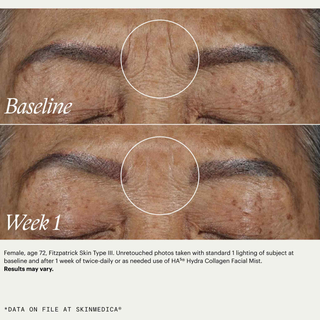 SkinMedica HA5 hydra collagen facial mist at skin type solutions before and after