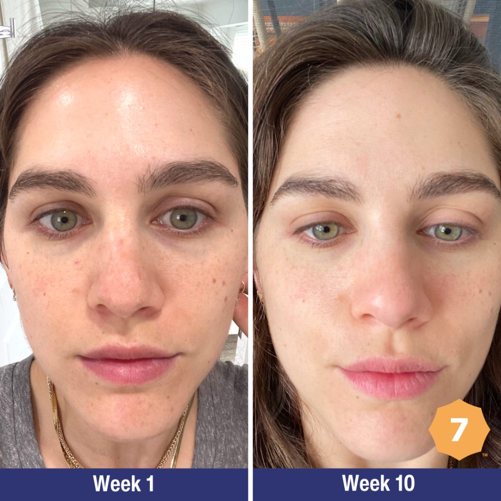 Before and after, Baumann Type 3, week 1 to week 11